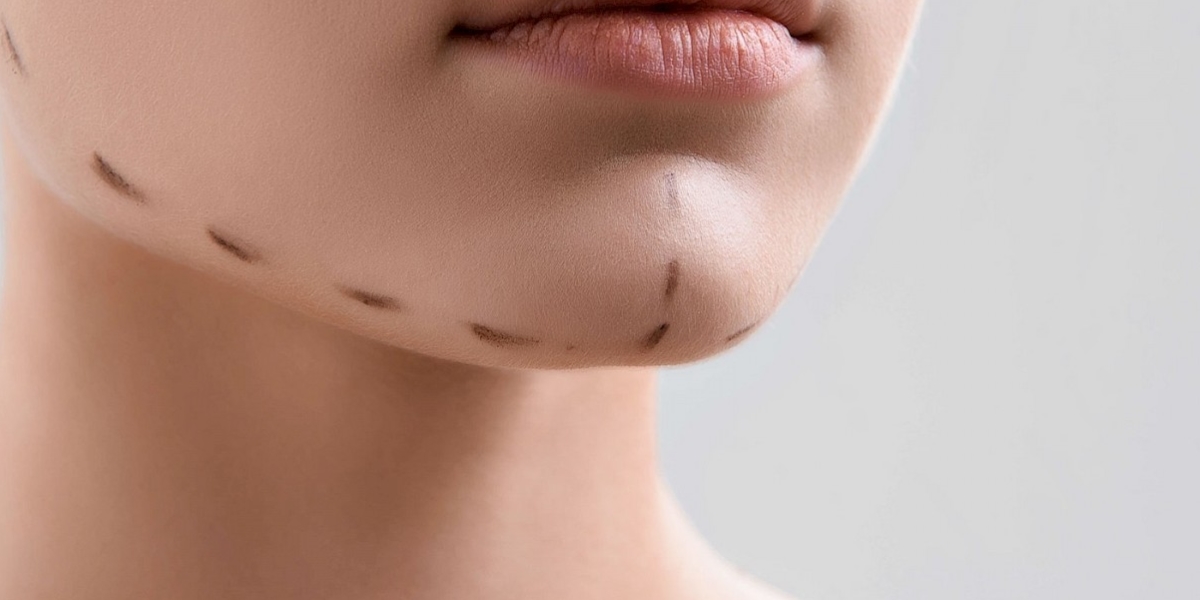Chin Implant in Istanbul, Turkey